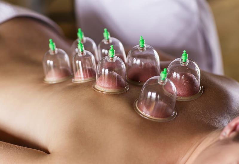Cupping therapy in Limassol, Cyprus – relaxing and rejuvenating treatment.